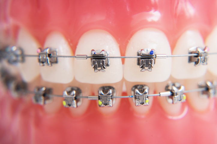 macro photography shows how the braces are arranged