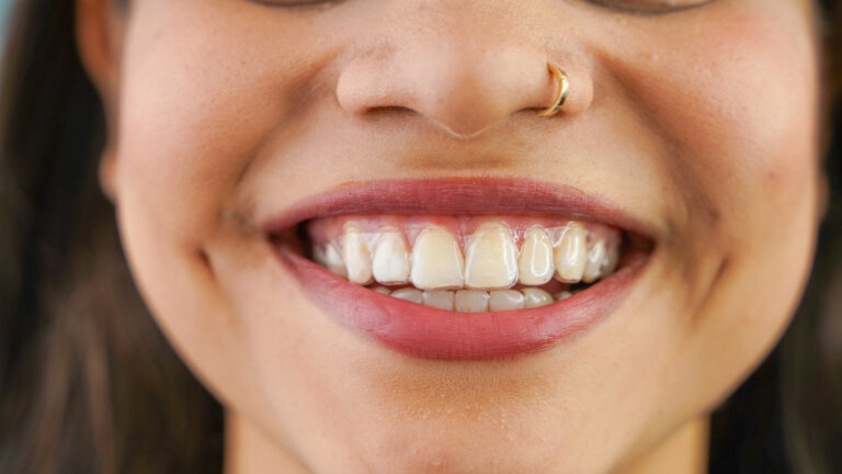 Young Asian Indian woman holding removable invisible aligner, also known as invisalign or clear aligner