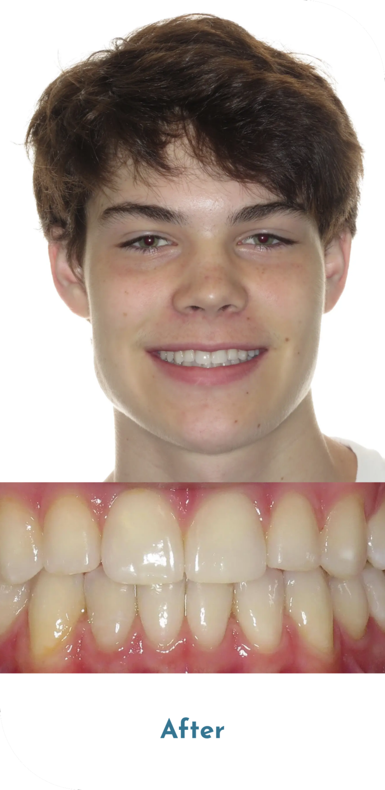 invisalign-treatment-after-1