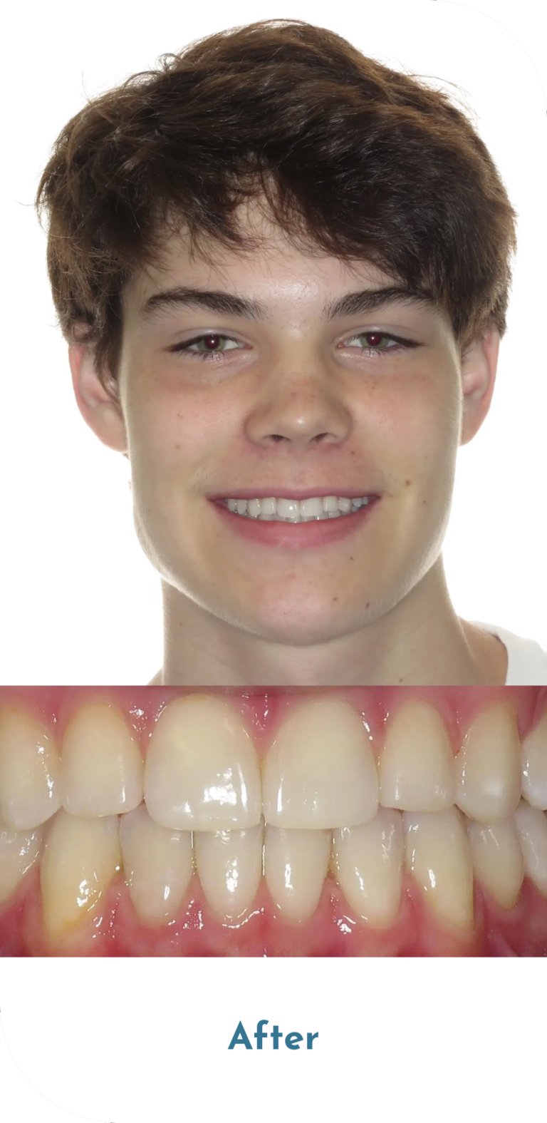 invisalign-treatment-after-1