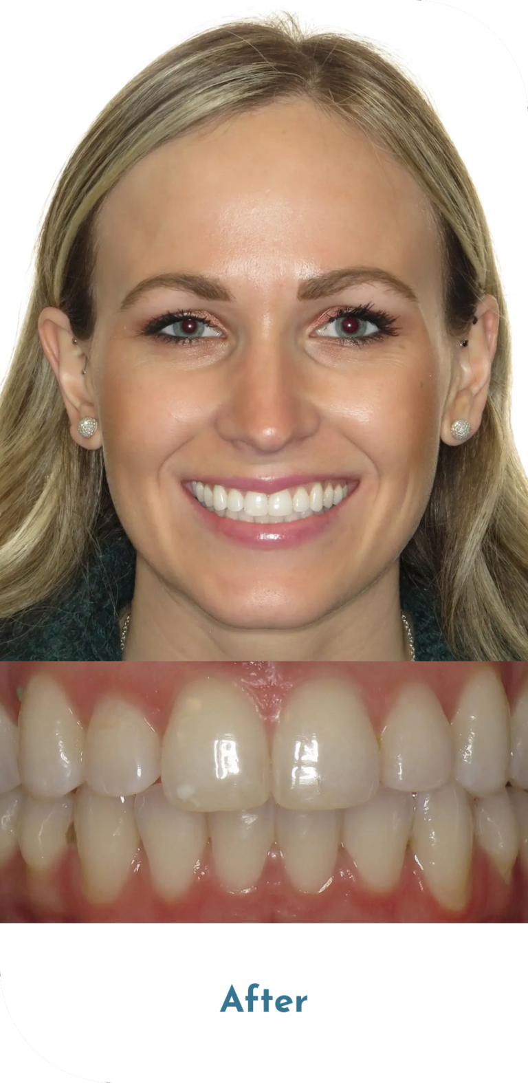 invisalign-treatment-after-2