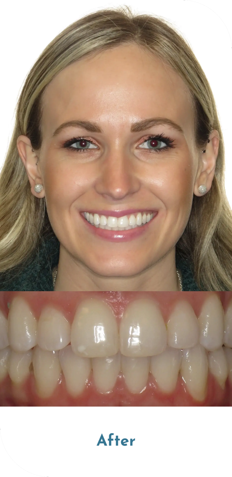 invisalign-treatment-after-2