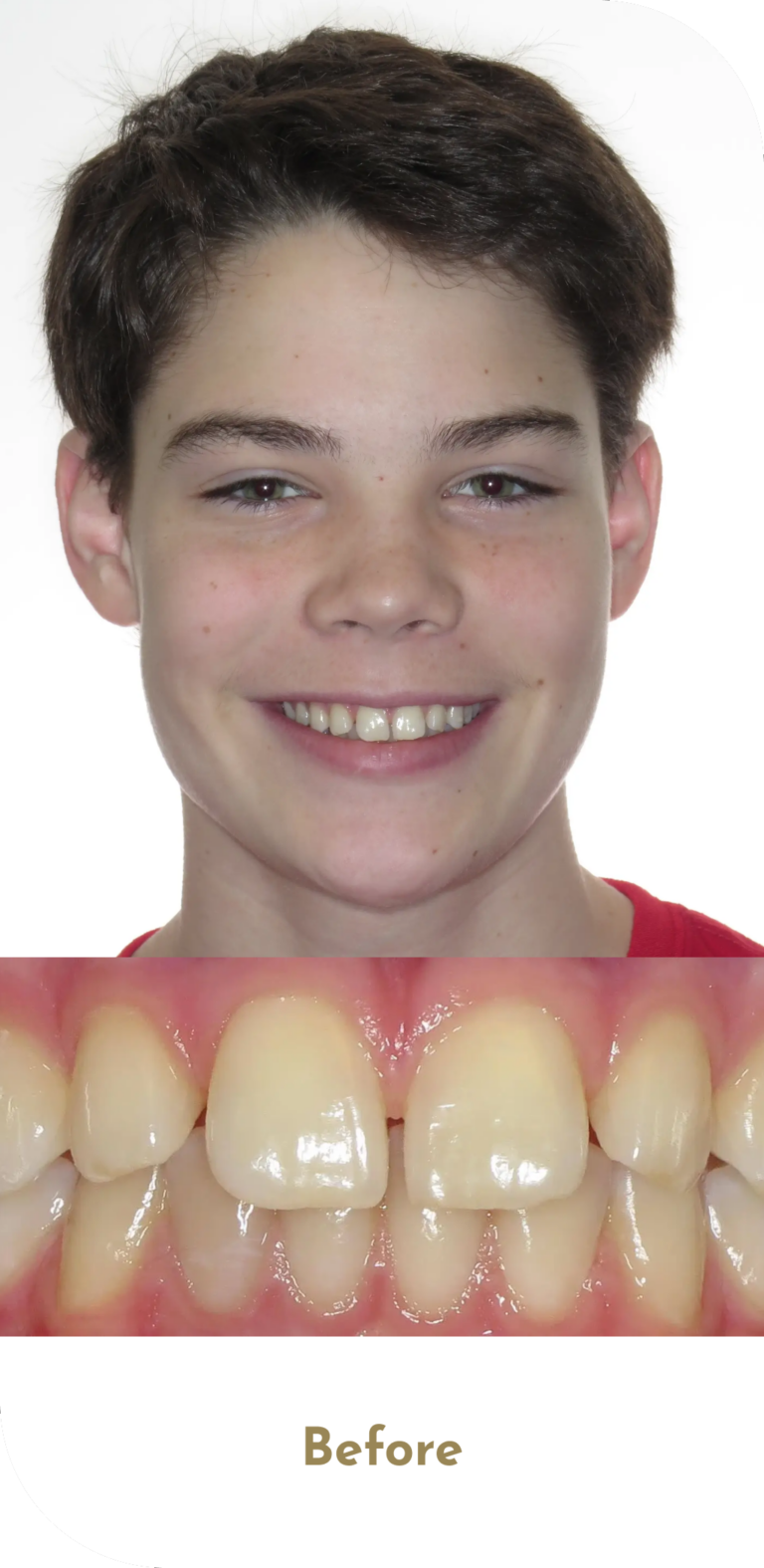 invisalign-treatment-before-1