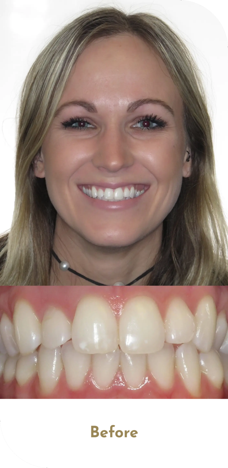 invisalign-treatment-before-2