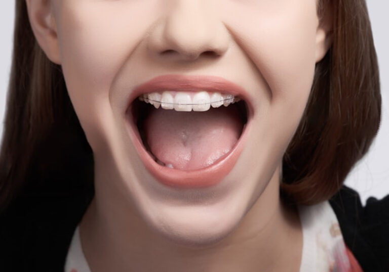 Smiling girl with Damon™ Clear Braces
