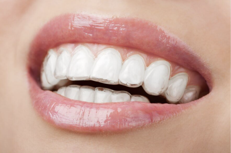 Smiling Woman Wearing Clear Aligners