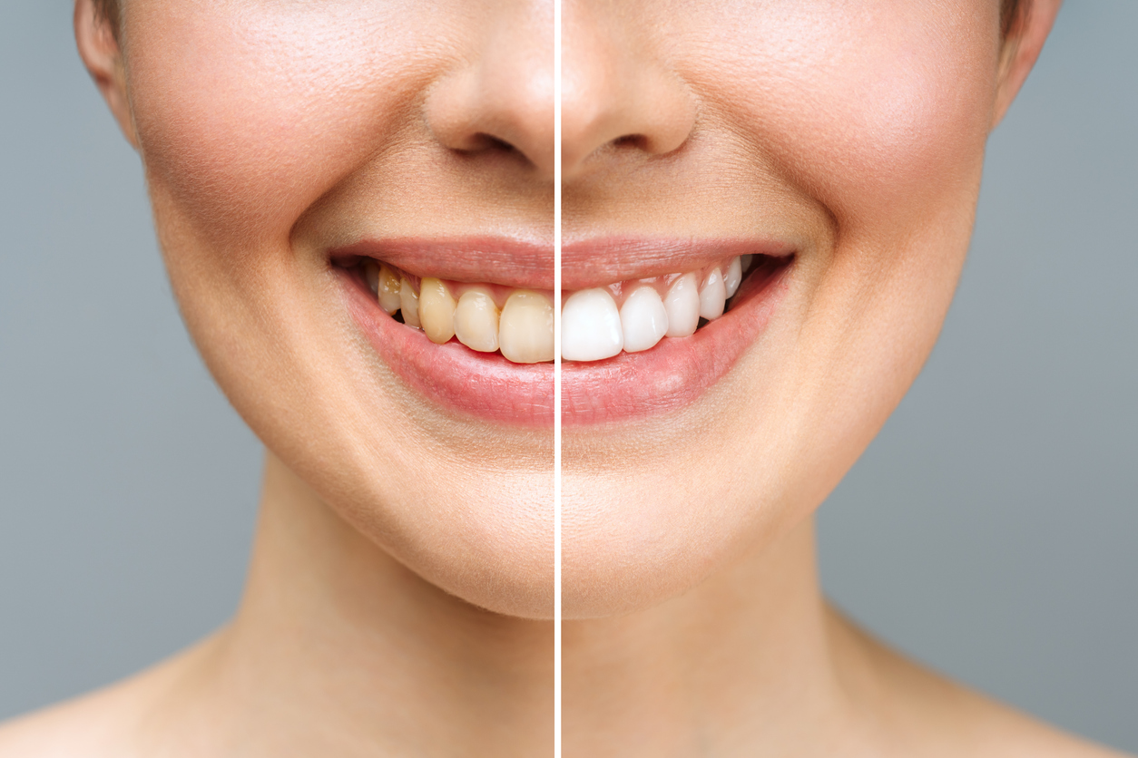 Before and after comparison of a woman’s smile before and after teeth whitening treatment